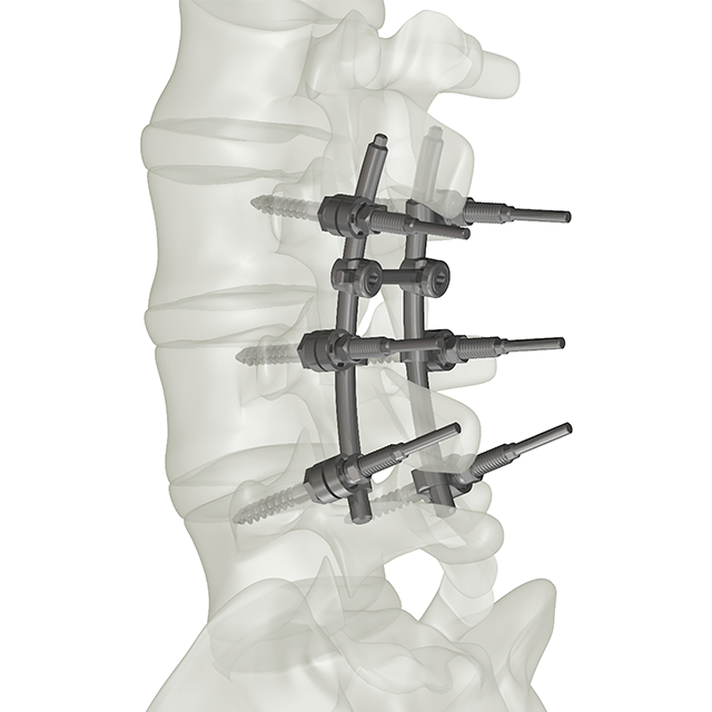 Spine posterior fixation system- CCS side loading