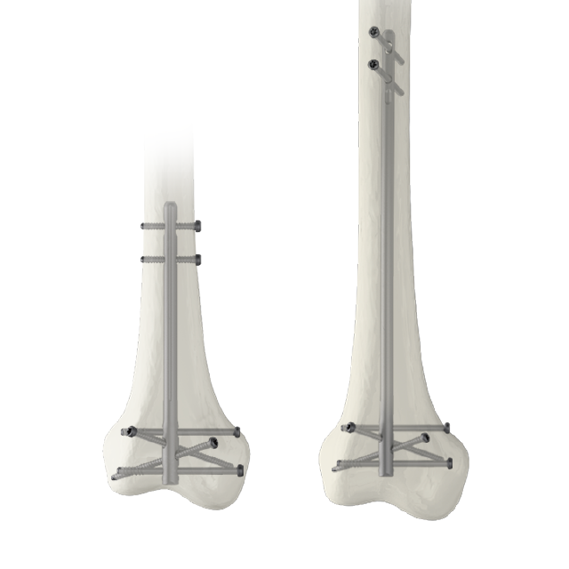 Ramic Intramedullary Nail System--Distal Femoral Nail