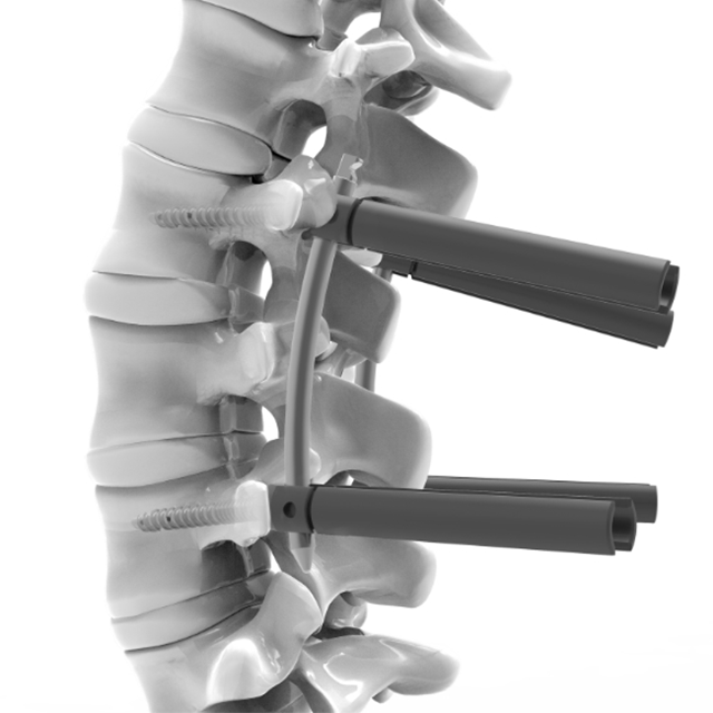 Spine posterior fixation system- MIS