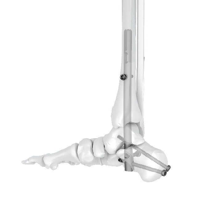 Ramic intramedullary nail system-Ankle Arthrodesis nail