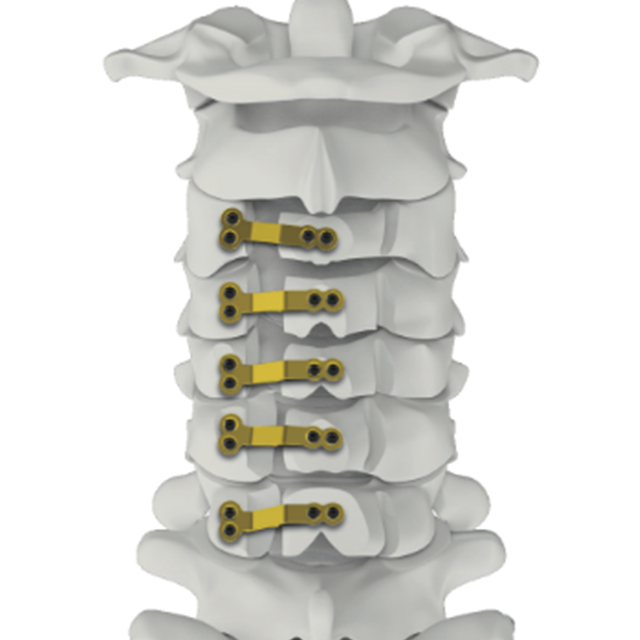 Coumic Cervical Plate System-Open Door Plate