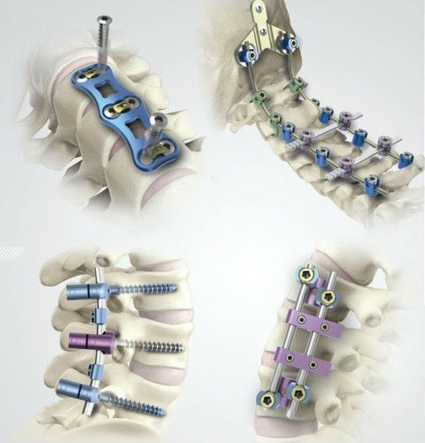 WHAT-IS-SPINE-IMPLANTS
