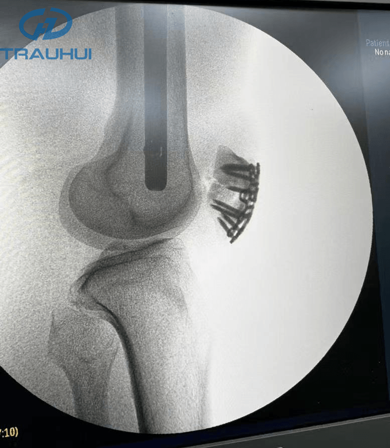 Anterior Patella Plates1.png
