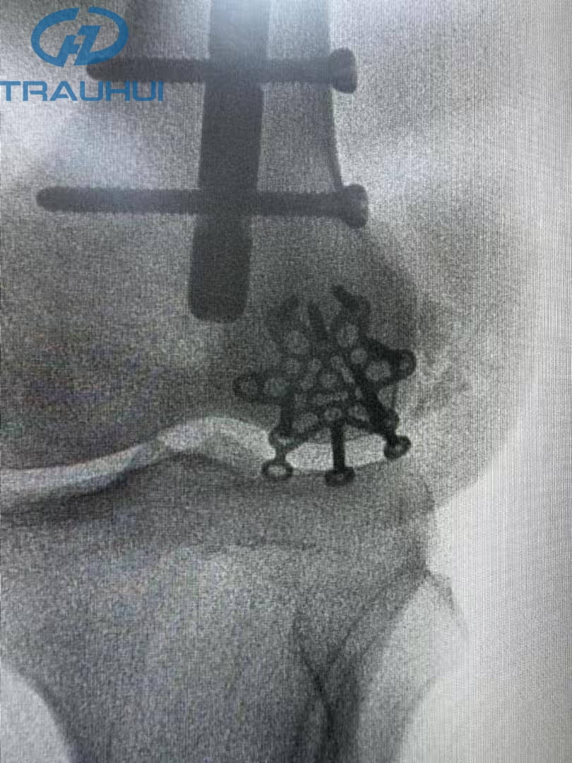 Anterior Patella Plates4.jpg