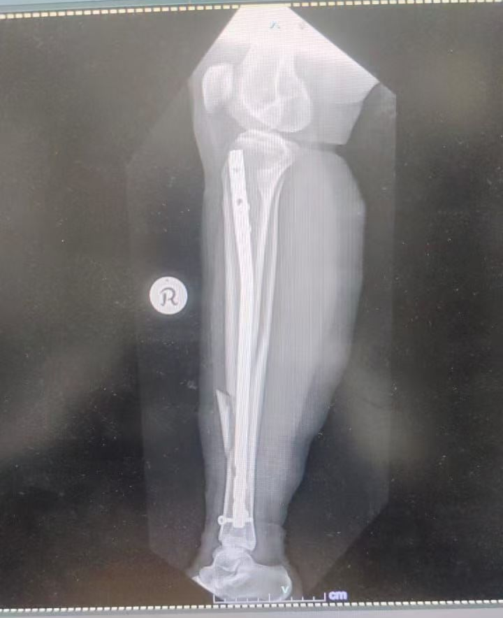 Subpatellar approach Xray (1)