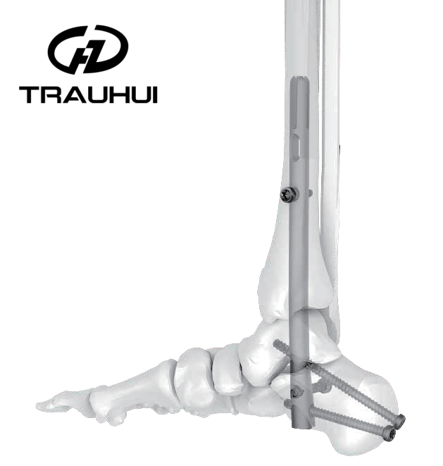 ankle fusion nail 6.png