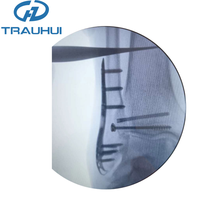 Distal Lateral Fibular Hook Plate5.png