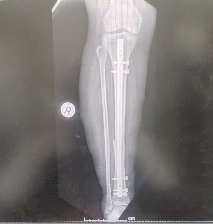 Subpatellar approach Xray (2)