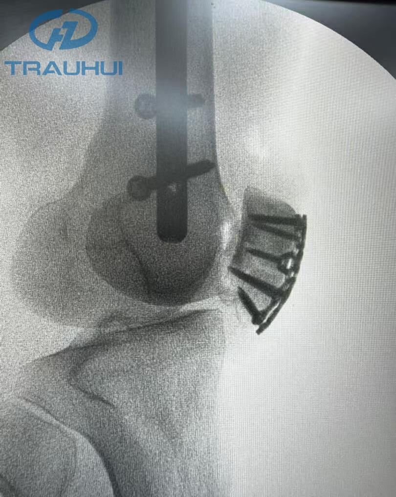 Anterior Patella Plates3.jpg