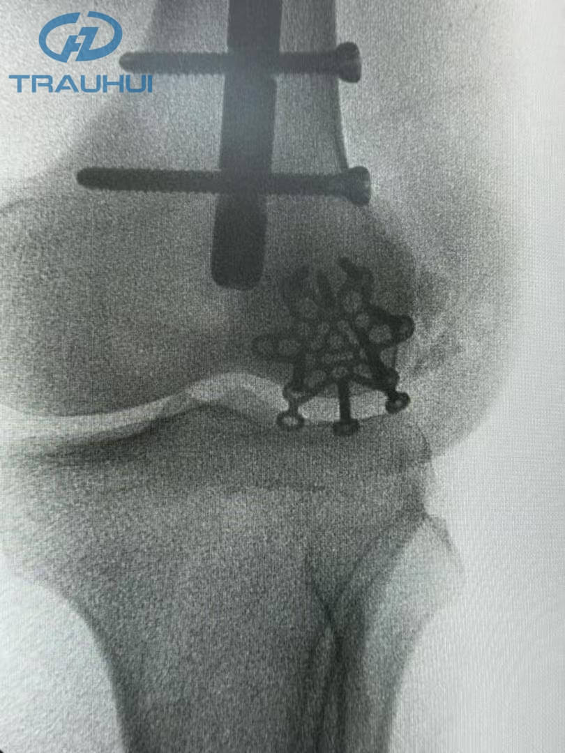 Anterior Patella Plates2.jpg