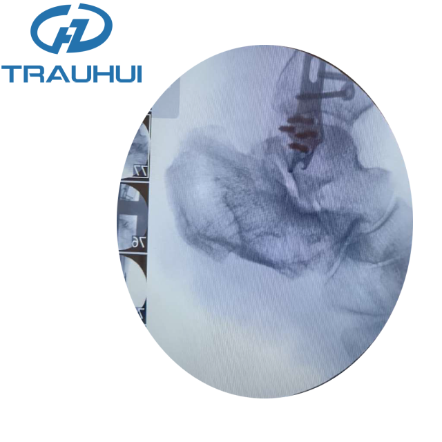 Distal Lateral Fibular Hook Plate1.png