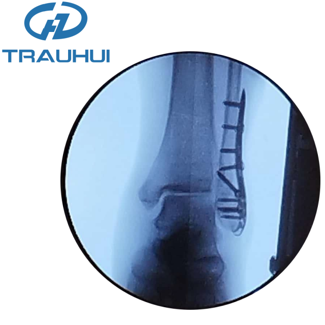 Distal Lateral Fibular Hook Plate2.png