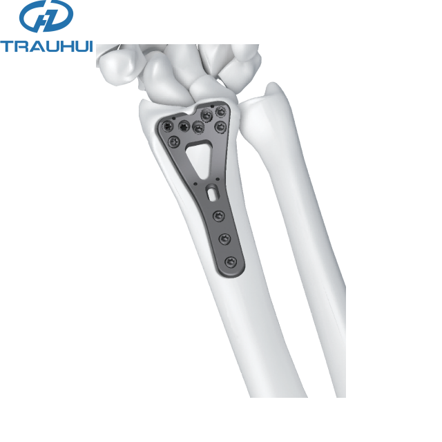 2.4 Distal Radius Volar Plates 9 holes head.png