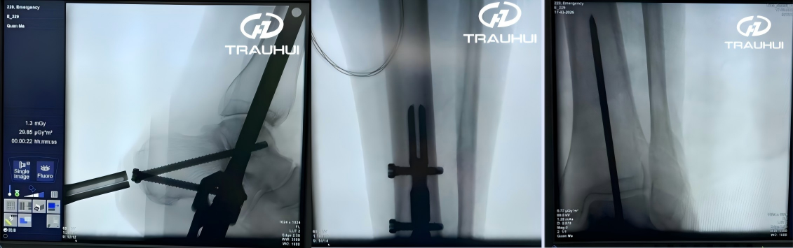 ankle fusion nail 7.png