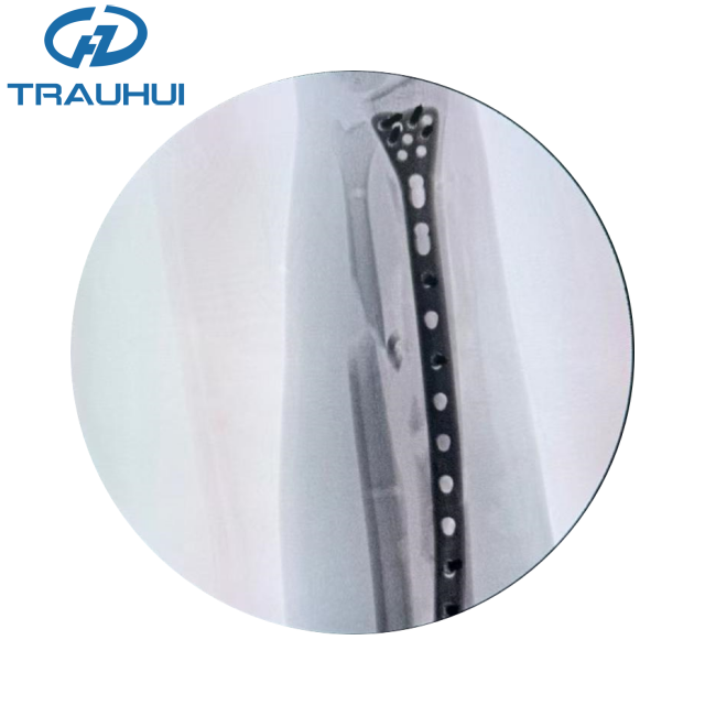 Distal Radius Volar Plates X ray 3.png