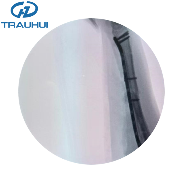 Distal Radius Volar Plates X ray 3 (2).png