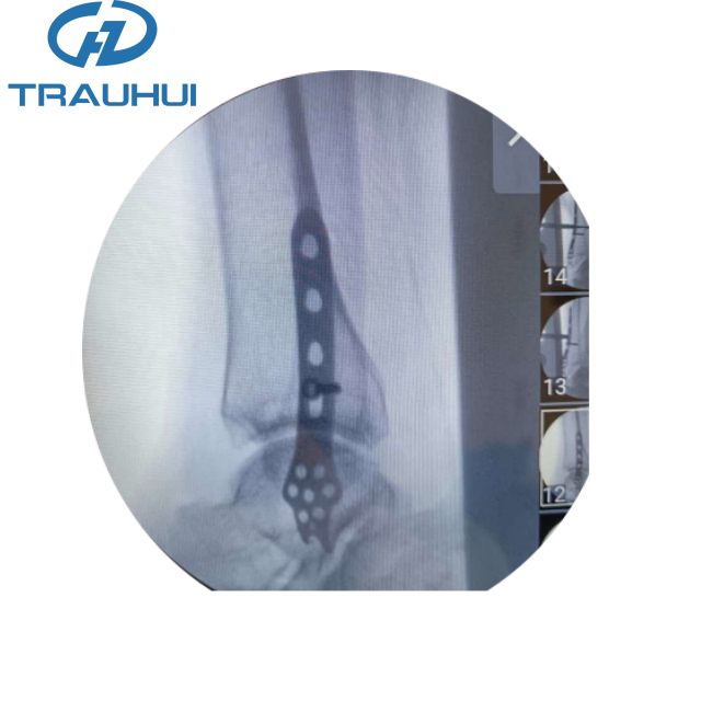 Distal Lateral Fibular Hook Plate5.png